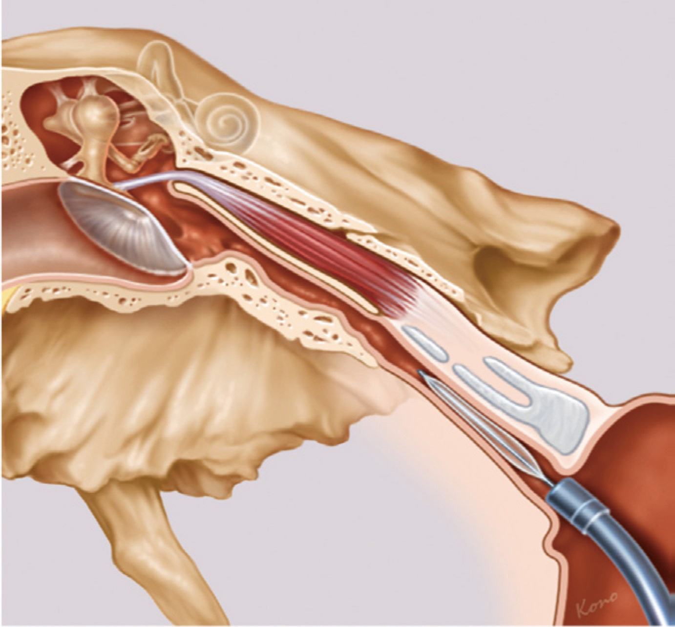 耳咽管氣球擴張成型手術01圖片來源SPIGGLEandTHEIS